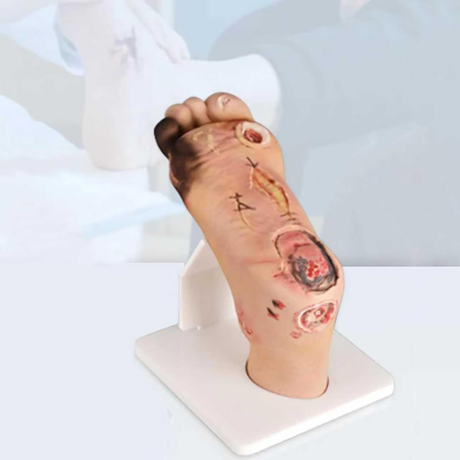 Model stopy cukrzycowej do anatomii i pielęgnacji ran, symulator stopniowy z ropnymi zmianami (poziomy 1-5), idealny do treningu medycznego i edukacji pacjentów (B)