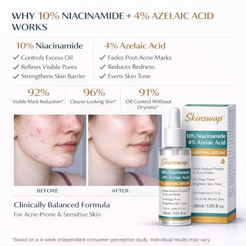 Image of Active 14% Niacinamide Serum with Azelaic Acid | Clarifying Face Serum for Brightening & Oil Control | Helps Reduce Acne, Blemishes & Acne Marks | Smooth, Clear-Looking Skin | For Women & Men | 30 ml