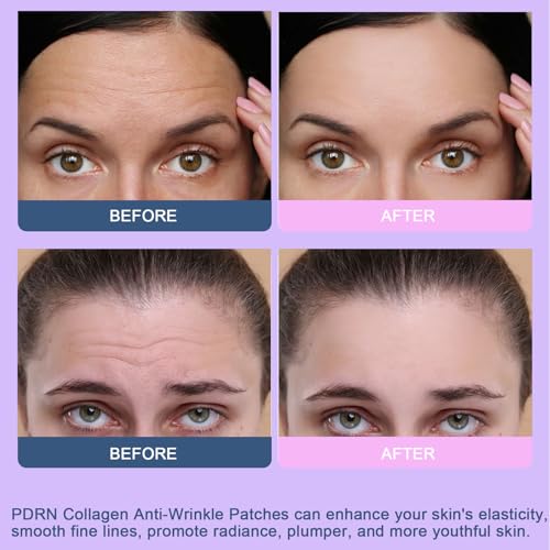 Kewhunt Forehead Wrinkle Patches - 16 Pcs, $9.xx with Coupon - Image 5