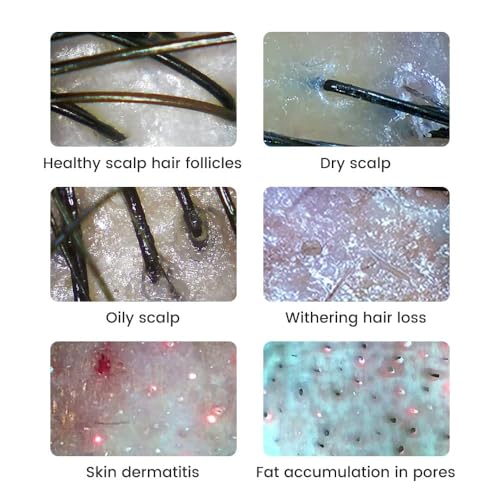 Image of Handheld Dermatoscope Skin Analyzer Machine, Wireless Portable Digital Microscope with 1080P IPS Screen 8 LEDs, 500X Magnifier, for Scalp /Hair Trichomes Facial Skin Dermatoscope