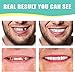 1Set Dentures Veneers Tooth,Dental Care Kits for Anti Molar Orthodontic Cosmetic Teeth,Smile Snap Tooth.(White,1Top+ 1Bottom+2Adhesives+1Tweezers+1Heart-Shaped Storage Box）