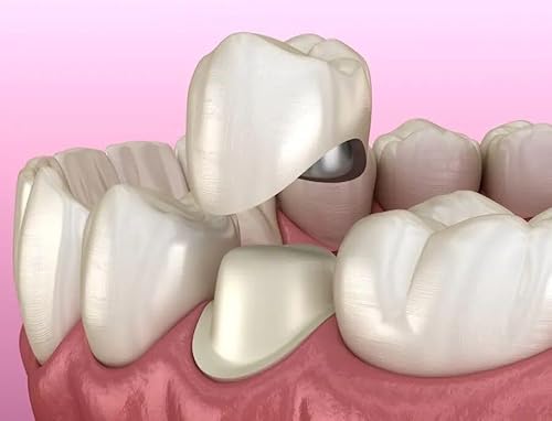Dental Crown Problems: Causes, Fixes, and Prevention