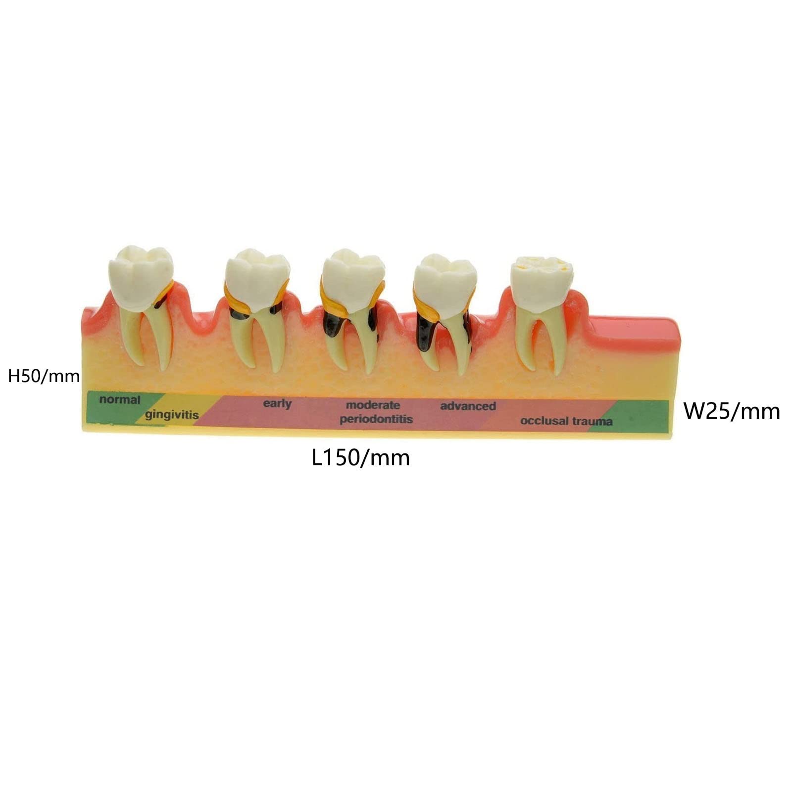 Model zmian przyzębia dentystycznego do nauczania, badania chorób przyzębia, rozwój próchnicy zębów i zębów narzędzie edukacyjne, realistyczna anatomia dla uczniów