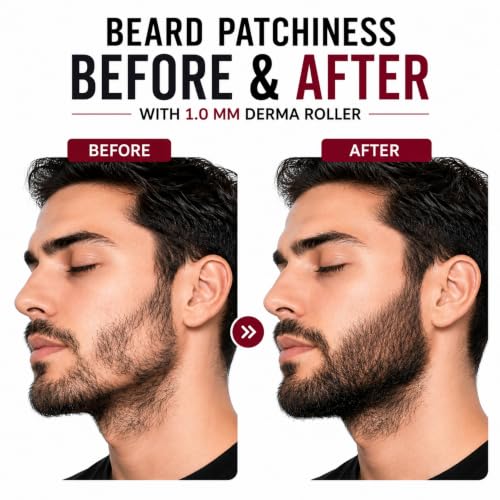 Image of Derma Roller for Hair and Beard Regrowth (1MM GuaSha Combo)