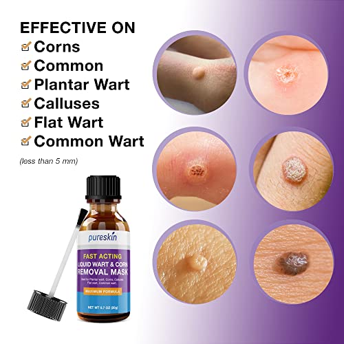 Pureskin Foot Corn Remover, Corn Removal For Toes, Corn Removers For Feet Extra Strength, Liquid Corn And Callus Remover #TOP2