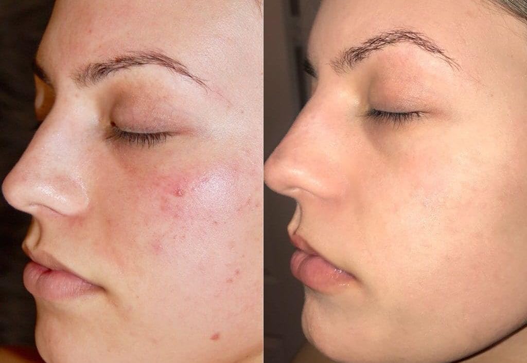 SERUM FACIAL 5 EN 1 - GLUTATIÓN,ÁCIDO HIALURÓNICO, VITAMINA C, VITAMINA E Y NIACINAMIDA - ANTIMANCHAS E HIDRATANTE, ANTIEDAD, ILUMINADOR, ANTIACNÉ, CONTROLADOR DE GRASA Y REAFIRMANTE - 30 ML