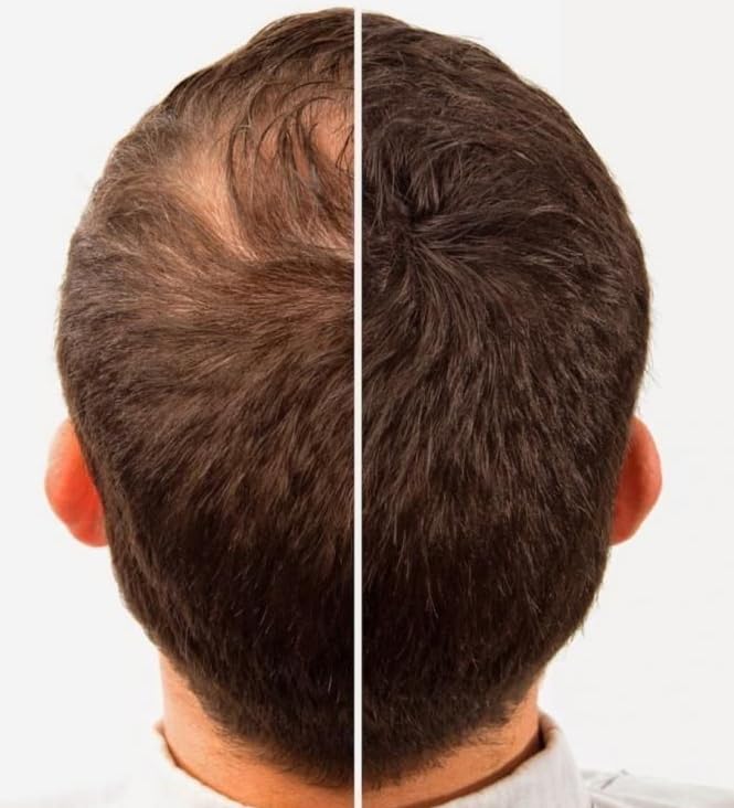 Hair Building Fibers 100% Wool - Natural Keratin. Size: 1/2 a Pound (227Grams) Bulk Refill Pack 60-80% SAVINGS. Thinning Hair/Bald Spots Toppikk, Sure Thick & Bosley. (Medium Brown, 227 grams)