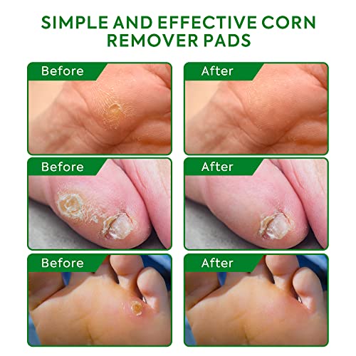 Corn Removers For Feet & Toes, Corn Removers With Salicylic Acid, Corn Removers For Toes Pads, Foot Corn Remover & Callous Remover, Corn Pads For Toes & Feet, 24 Pack #TOP2
