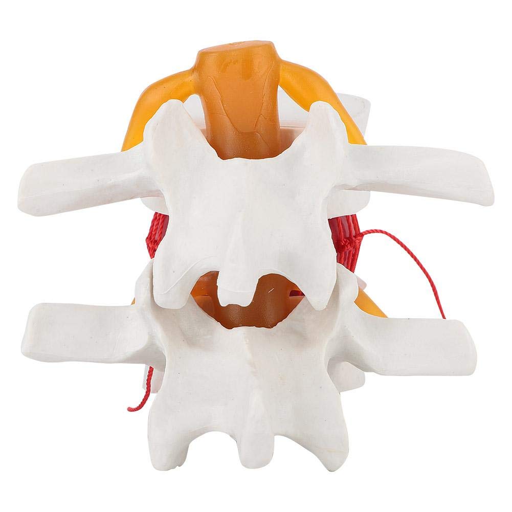 1 : 1 5 Insegnamento medico Modello dimostrativo di vertebre vertebrali lombari Vertebre degenerative Colonna vertebrale umana Venduta Anatomia Modello di ernia del disco lombare