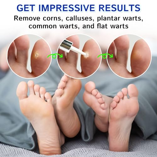 Image of Ulensy Corn Remover Liquid for Toes Feet: 20ml Salicylic Acid for Foot Corns Calluses Wart Removal at Work Home - Safe for Kids Teens Adults Seniors Athletes Runners Workers Men Women