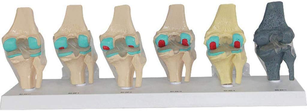 Modèle de blessure au Genou en 6 étapes - Le Genou modèle Anatomique Joint - Affichage de la Science de l'étude en Classe avec des modèles de Rubans et de matériel médical