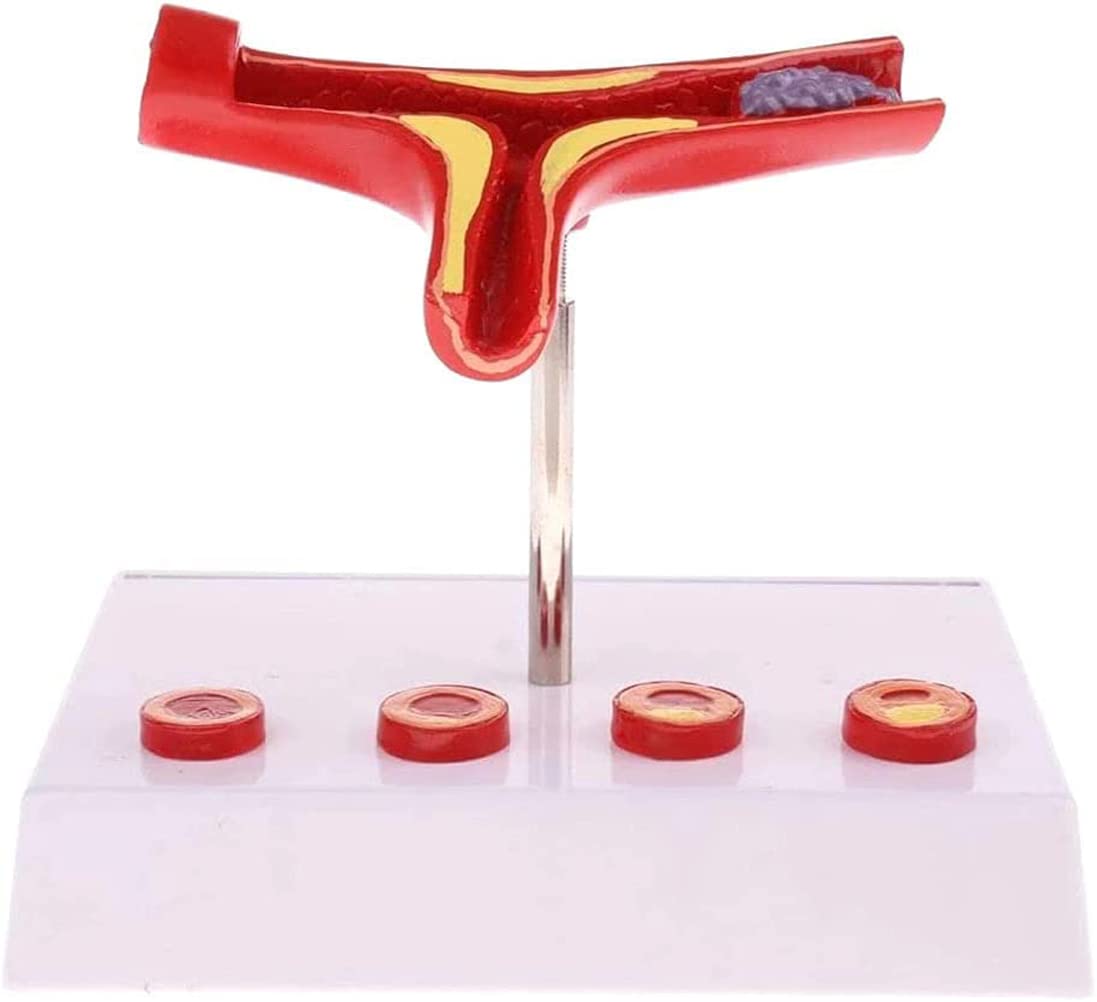 Modèle de Thrombus athéroscléreux vasculaire Humain avec Base Modèle pathologique cardiovasculaire Modèle médical Matériel pédagogique