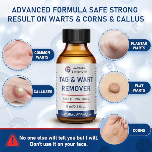 Image of inchSTAY STOKED inch Wart Remover, 15ml Liquid Wart Freeze Off - Salicylic Acid Formula with Brush Applicator-QQ1