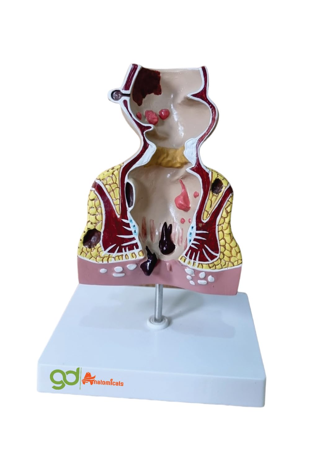 G.D. Anatomicals®"Human Body Anatomy Rectum Model with Common Pathologies - Educational Tool for Doctors' Offices, Medical Professionals, and Healthcare Practitioners - Lifesize 3D Replica of the Rectum Measuring 17 x 13 x 23 cm for In-Depth Study and Enhanced Medical Training - Ideal for Clinical Settings, Medical Practices, and Colorectal Health Education"