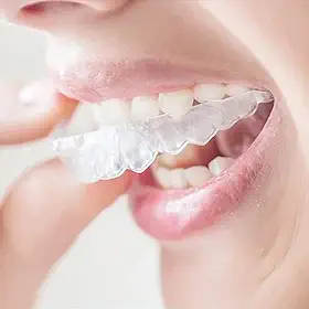 Protetor bucal noturno antimoagem para homens e mulheres – Tratamento profissional de bruxismo – termoplástico reutilizável combinado com solução de silicone para fechamento dentário – Bocal confortável