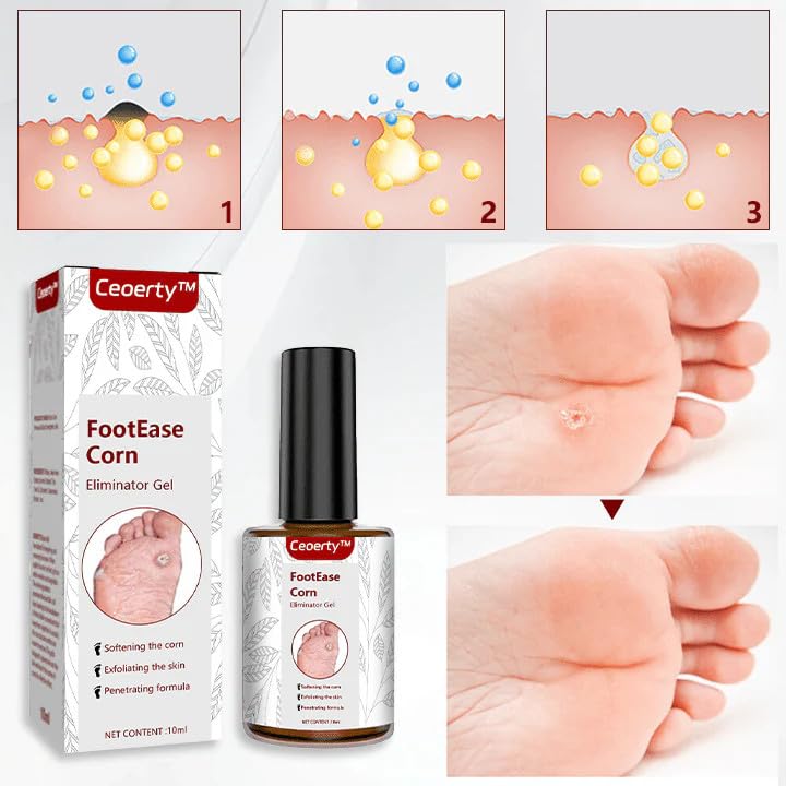 Image of BINGEABLE CornCare Foot Gel | Fast-Acting Corn & Callus Remover | Gentle Formula for Soft Feet | 30ml