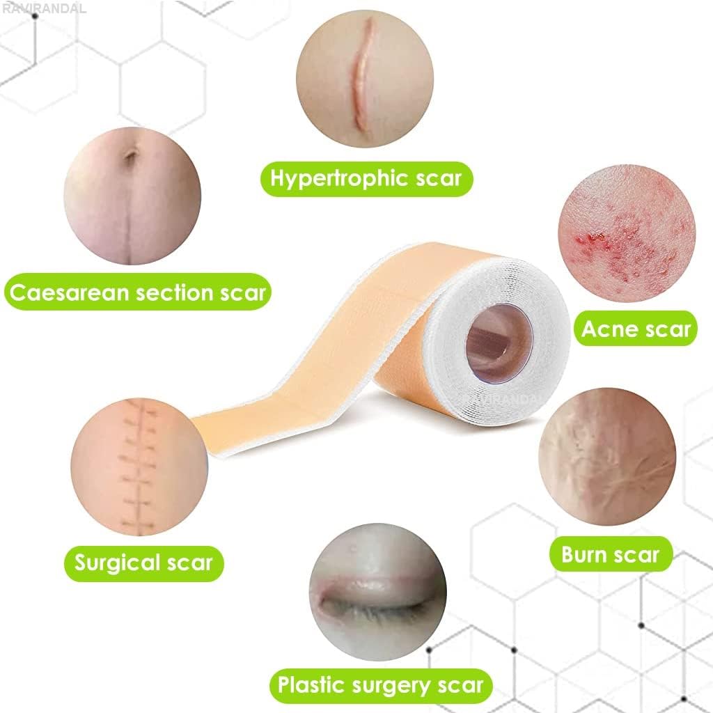 RAVIRANDAL Silicone Scar Sheets, Silicon gel sheets for Scars Transparent Medical Silicone Gel Tape for Scar Removal, Silicone Scar Tape Roll For Hypertrophic Scars and Keloids Caused by Surgery 1