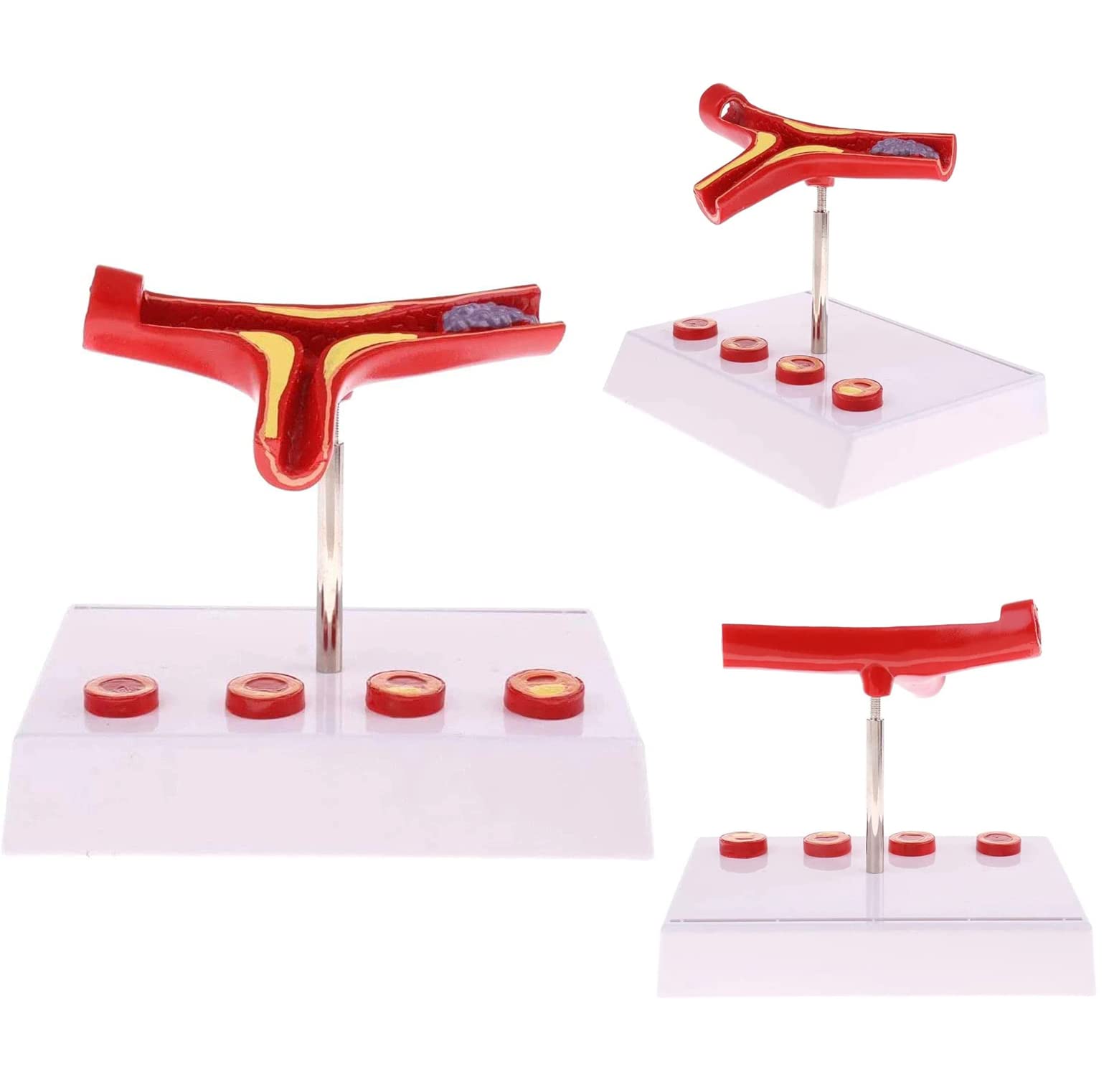 Modèle de Thrombus athéroscléreux vasculaire Humain avec Base Modèle pathologique cardiovasculaire Modèle médical Matériel pédagogique