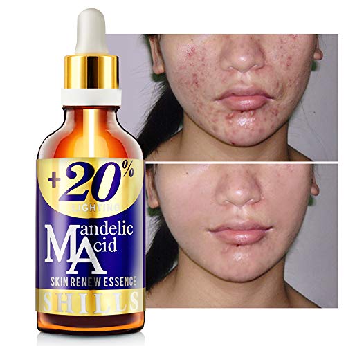 mandelic acid serum