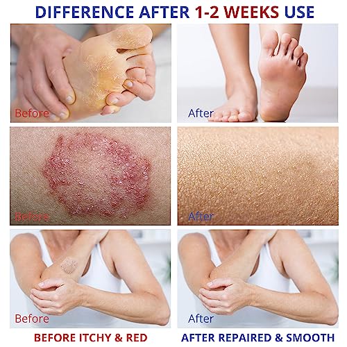 Charmpoo CHARMPOO-NV Athletes Foot Treatment-Antifungal Cream-Treatment thumb #2