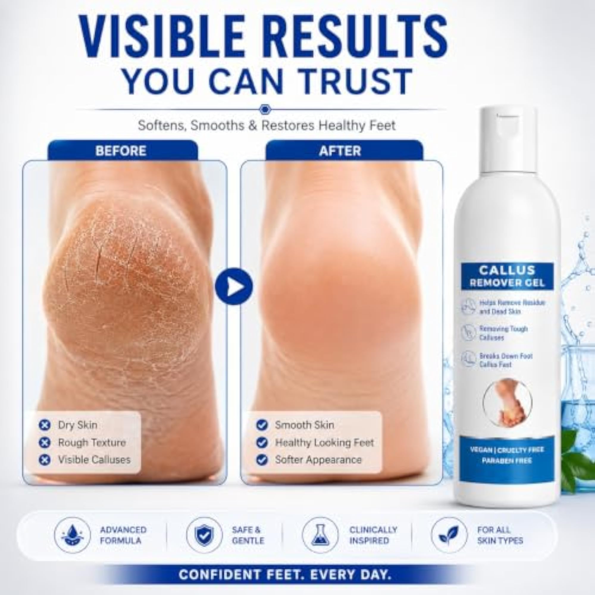 Foot Callus Remover Gel for Feet & Hands