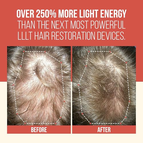 Image of LaserCap SD 80 - Professional Red Light Therapy Cap for Hair Growth - FDA Cleared Alopecia & Thinning Hair Treatment for Men & Women - 80 Medical-Grade Lasers, Cordless Rechargeable Design