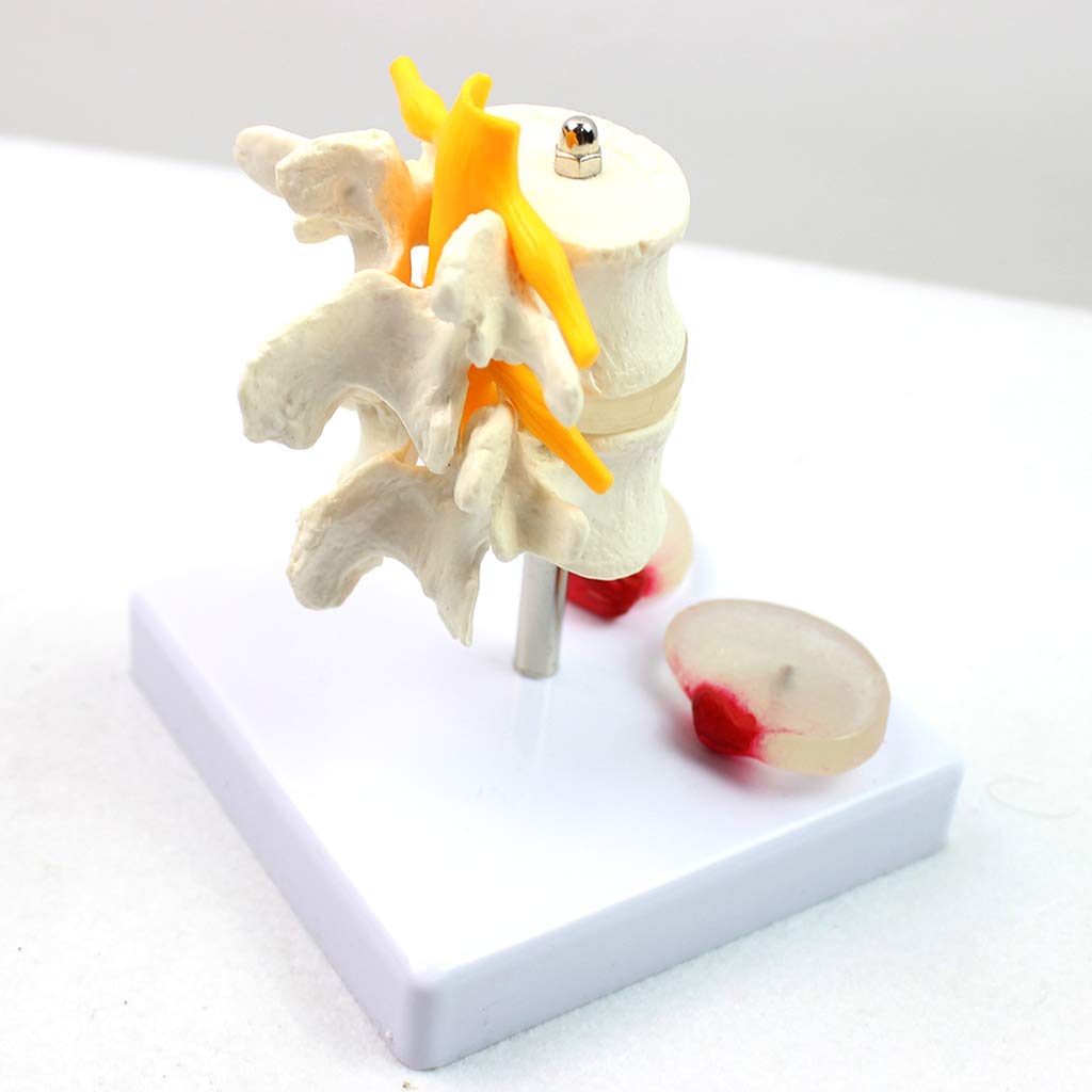 Sjdopulse Anatomical Skeletal Model Of Diseased Intervertebral Disc Model - Human Lumbar Spine Model - Medical Anatomical Human Spine Model - For Medical Educational Training
