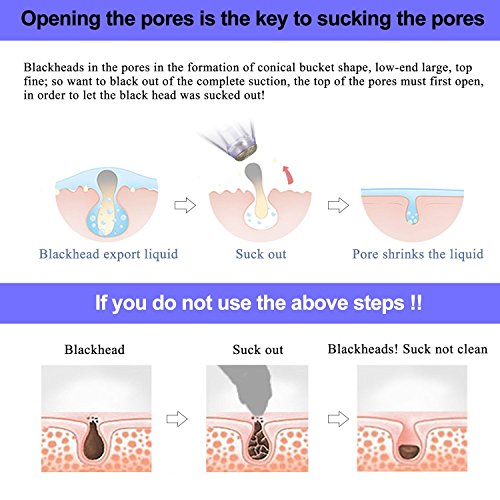 Extractor Blackheads Comedones Remover Pulitore di...