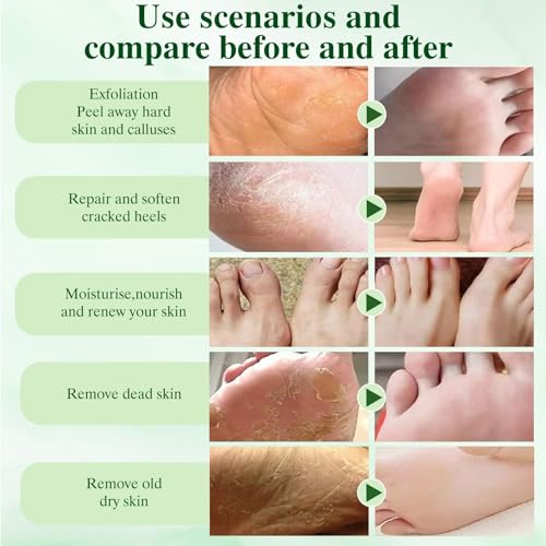 6 Pares Calcetines Exfoliantes para Pies,Mascarilla Pies Peeling, Mascarilla Hidratante para Pies, Foot Peel Mask, Cuidado Pies Secos y Agrietados,con Kit de Pedicura,Aloe Vera - imagen 7