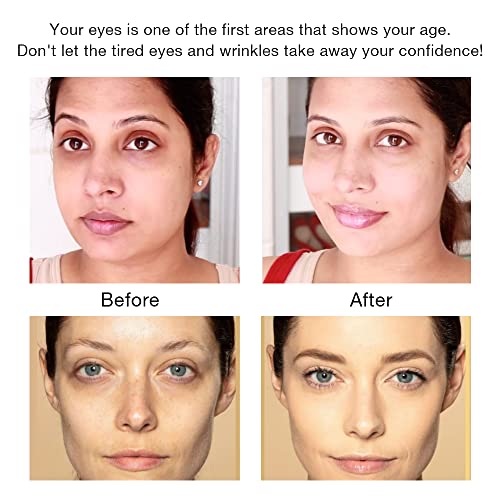 Eye Beauty Instrument, Eye Rf Anti Aging Device | Eye Bags | Puffiness | Dark Circles | Crow's Feet | Fine Lines | Wrinkles Removal Device, Home Radio Frequency Anti Aging Beauty Instrument For Eyes #TOP4