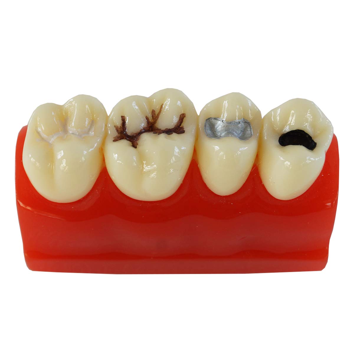 Modello di denti dentali per allenamento orale, chiusura a fessura e scanalatura, strumento educativo per anatomia umana, studio medico e simulatore di pratica