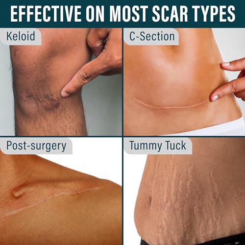 nuvadermis silicone scar tape for surgical scars - 12034 x 1534 roll - medical grade scar tape for wrinkles surgical scars keloid scars and hypertrophic scars - reusable scar sheets roll - 1 pack