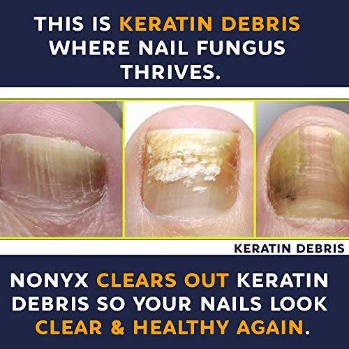 Nonyx NAIL GEL Fungal Nail Clarifying Gel | Rids Nails Of Fungus By Removing Keratin Debris Where Nail Fungus Grows | 90% Of Toenails Improved Using This Toenail Fungus Treatment thumb #7