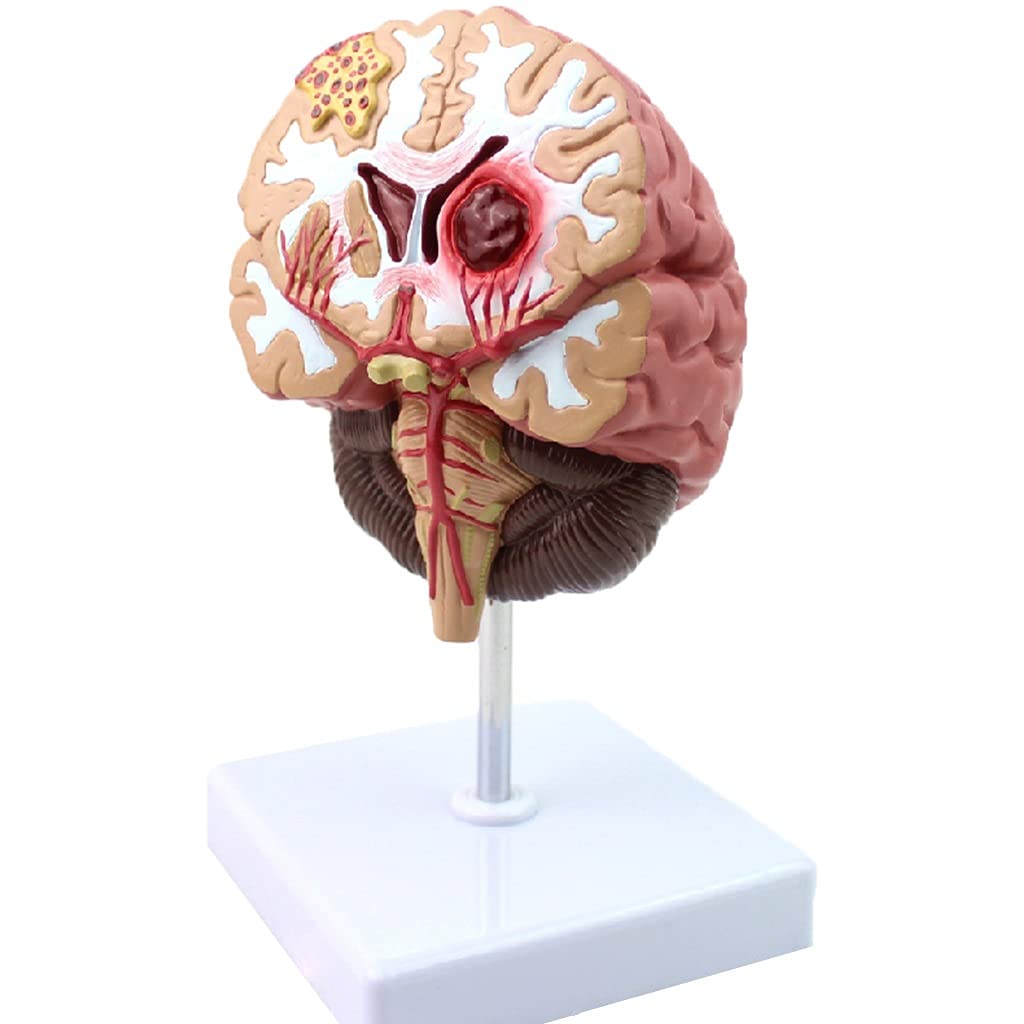 Buy QHYXT Anatomical Models Humans Brain Disease Model Neurosurgery