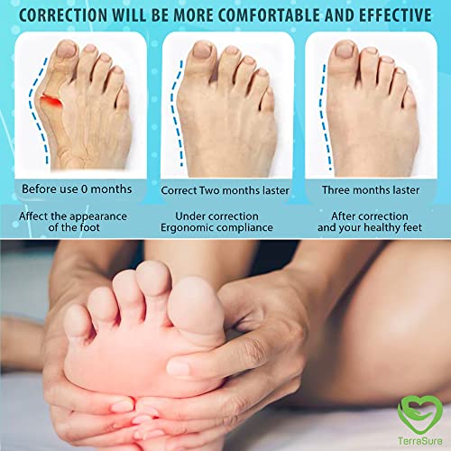 Terrasure Upgraded Bunion Corrector For Women & Men 2 Pcs, Non-Surgical Bunion Toe Corrector Comfortable & Breathable For Day/Night Support, Big Toe Separators For Hallux Valgus Pain Relief Size 4-10 #TOP5