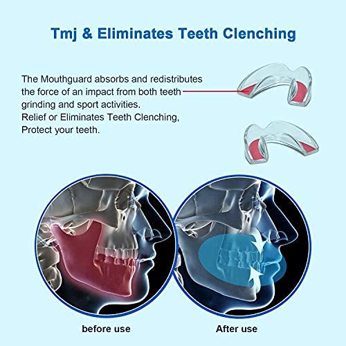 Longevity Turtle IV-0010 Kids Mouth Guard For Teeth Grinding, Pack Of 4 Bite Guards + Dental Guard Case, Eliminate Clenching Bruxism, Teeth Whitening Tray & Sports, Child Moldable Bite Guards thumb #2