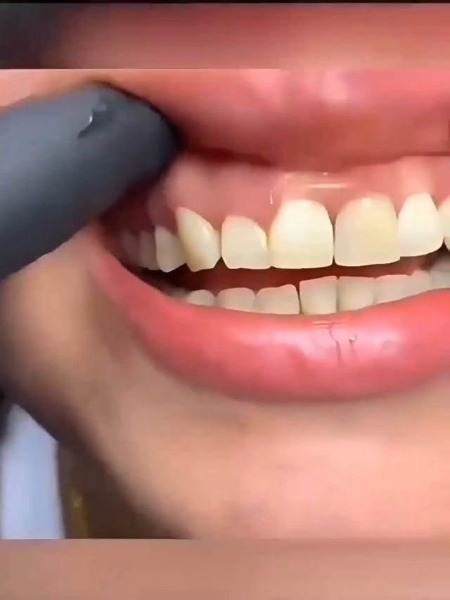 【数量限定】1本 カスタム 入れ歯 部分 取り外し可能 Dentellea 義歯 Amazon.co.jp: Dentellea カスタム 入れ歯 部分 取り外し可能 義歯