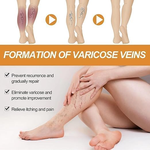 Image of Varicose Veins Spray - Natural Herbal Formula for Fast Relief | Reduces Swelling, Relieves Pain & Promotes Blood Circulation | Easy-to-Use Spray for Legs, Ankles & Feet (pack of 1)