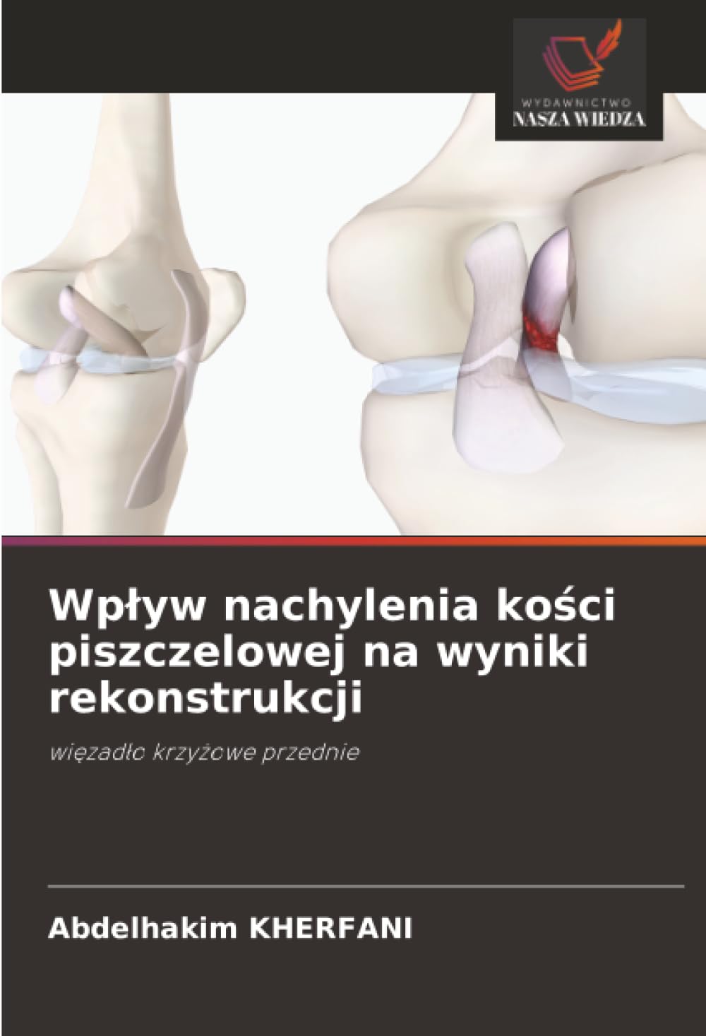 Wpływ nachylenia kości piszczelowej na wyniki rekonstrukcji: więzadło krzyżowe przednie: wi¿zad¿o krzy¿owe przednie