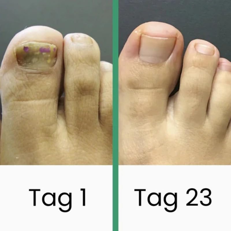 Podomax PODOclip® | LLLT-Nagelpilztherapie(1 Stück)
