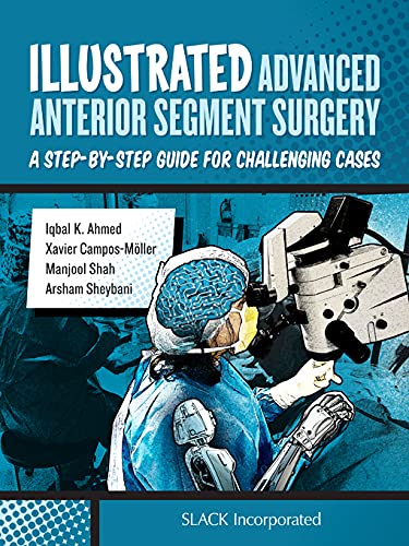 Illustrated Advanced Anterior Segment Surgery: A Step-by-Step Guide for Challenging Cases Illustrated Advanced Anterior Segment Surgery: A Step-by-Step Guide for Challenging Cases