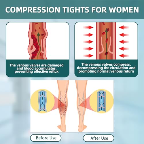 2 Pairs 20-30mmHg Compression Pantyhose for Women, Medical Graduated Compression Stockings Leggings Footless Support Compression Tights for Varicose Veins, Swelling, Edema (Black+ Beige)