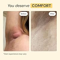 Vista 4 de MyMagicHealer Cuidado Universal para Inflamaciones Ungüento de Atracción para HS, Forúnculos, Quiste, Hemorroides, Quiste Pilonidal, Absceso