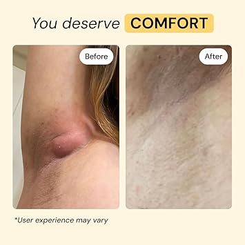 MyMagicHealer Universal Flare Care Solution for Everyday Skin Flare-Ups | Drawing Salve for Boils & Cysts, Hidradenitis Suppurativa, Folliculitis | Irritated Skin and Chafing Relief 1 oz