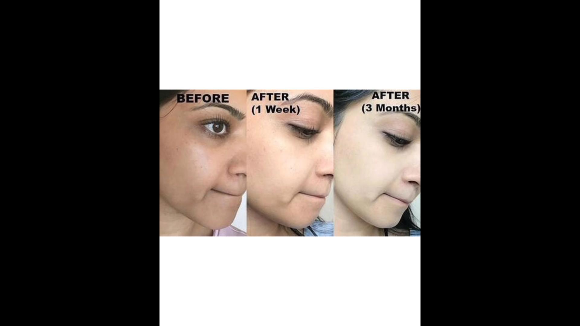 will glutathione lighten skin permanently for Lightening : Is it Safe & Does it Really Work Amazon.com: Fleamart Glutathione Supplement 98%+