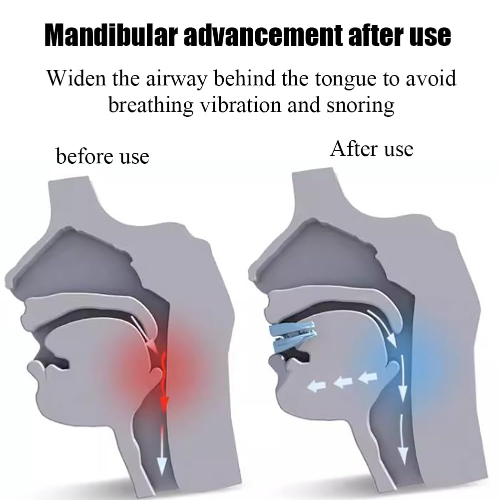 Maison Intelligente, Aide à la réduction du ronflement pour Le grincement des Dents et Une Respiration Fluide - Dispositif Anti-ronflement avec 12 Niveaux de ré