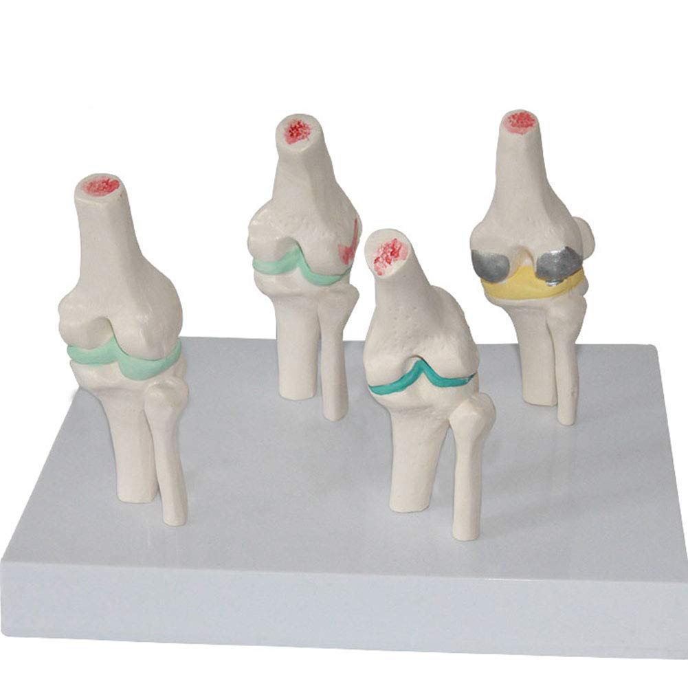 sjdoPulse Human Knee Joint Model - 4 -Stage of Joint Disease Model -Medical Anatomical Knee Joint Model - Knee Lesion Model - for Medical Educational Training Aid