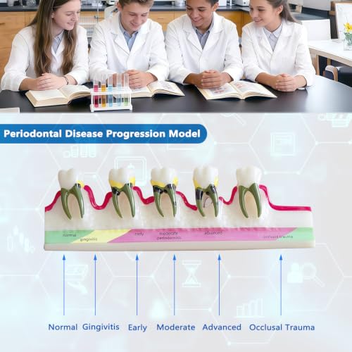 Image of Periodontal Disease Classification Model, 5-Stage Dental Anatomy Model for Dental Education,Dental Training,Demonstrations,Oral Care Education