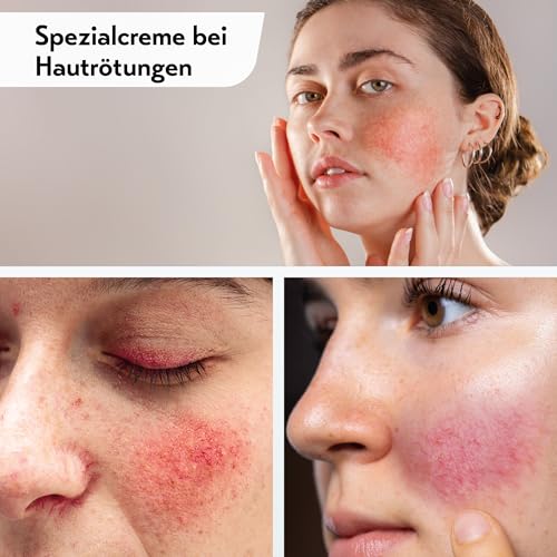 Couperose-Creme Deruba – Spezialcreme gegen Rötungen mit LSF 50+