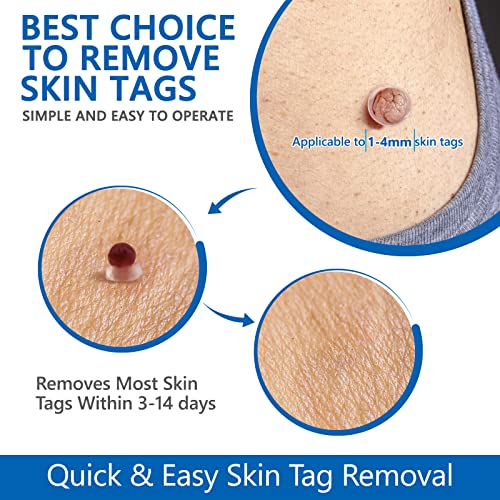 Warzen Entfernungs-Set, Auto Tool Kit Skin Tag Remover, Schmerzfrei Automatisches Stiftset Hautmarken Entferner… – Ansicht 2